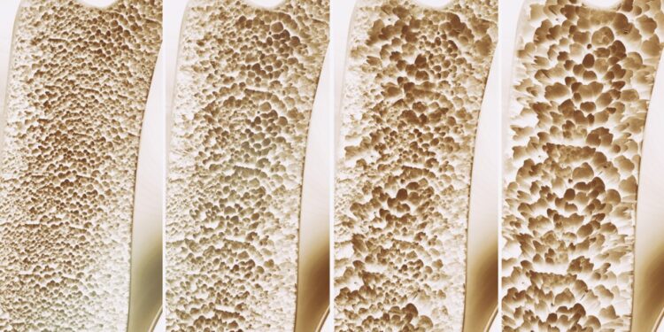 Ο αλγόριθμος μηχανικής μάθησης ξεπερνά τις υπάρχουσες μεθόδους για την πρόβλεψη του κινδύνου οστεοπόρωσης. Υπόσχεται έγκαιρη διάγνωση και θεραπεία της νόσου.